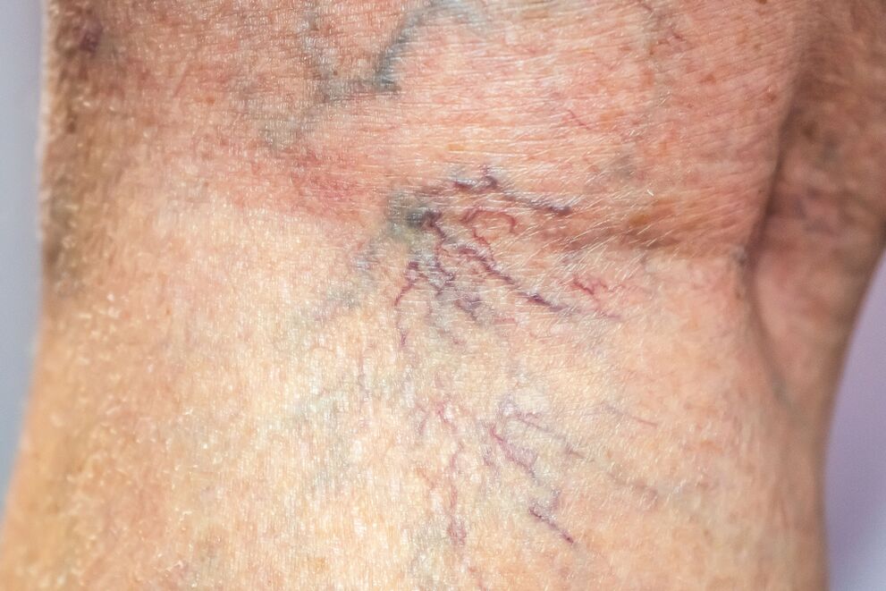 Varices no corpo