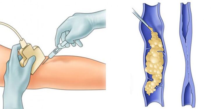 Tratamento de varices