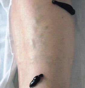 Hirudoterapia como método para tratar as varices