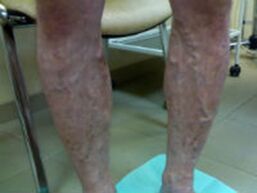 Varices nas pernas