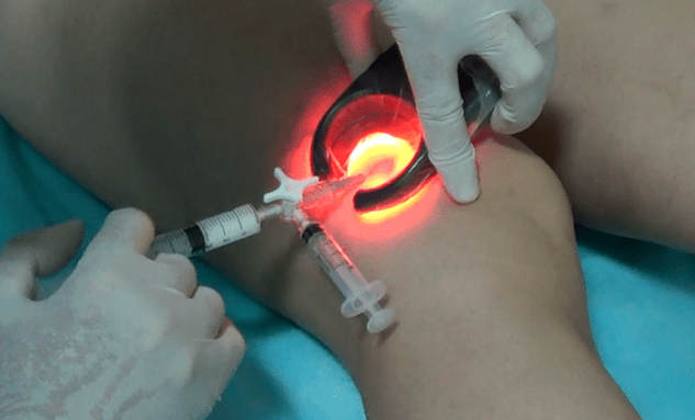 A escleroterapia é un método eficaz para tratar as varices nas pernas