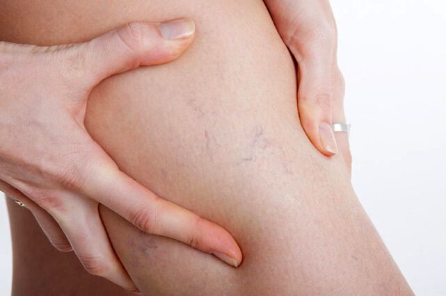 A primeira aparición de varices na perna