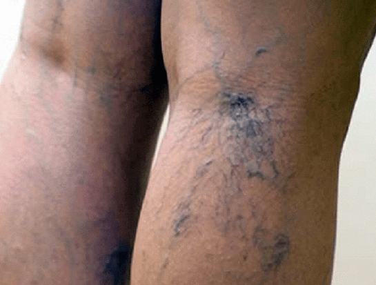 Varices nas pernas